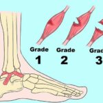 distorsione caviglia